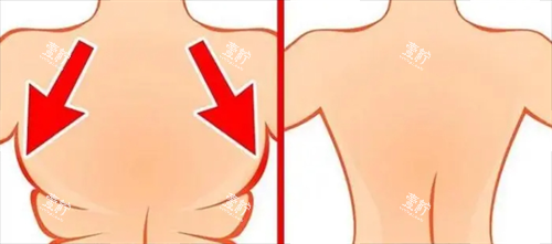 背部吸脂前后动画对比图.png