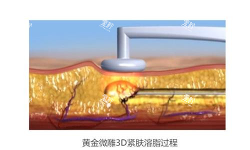 黄金微雕示意图.png