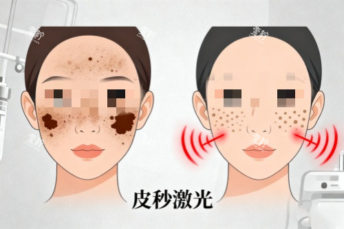 脸部做皮秒激光祛斑卡通图.jpg