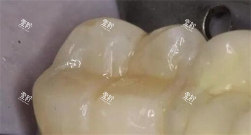 3M树脂补牙.jpg