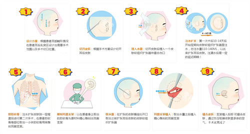 扩张器法耳再造手术动画演示图.jpg 扩张器法耳再造手术动画演示图.jpg