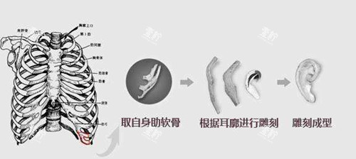 肋软骨耳再造支架.webp.jpg 肋软骨耳再造支架.webp.jpg
