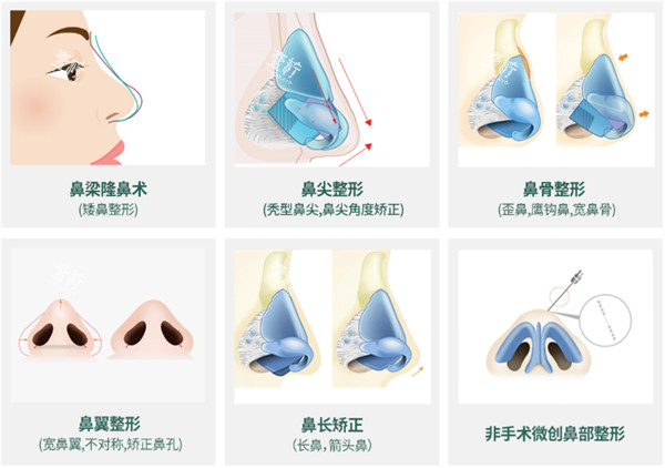 隆鼻手术方法.jpg 隆鼻手术方法.jpg