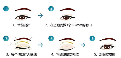 双眼皮三点术过程原理.jpg 双眼皮三点术过程原理.jpg