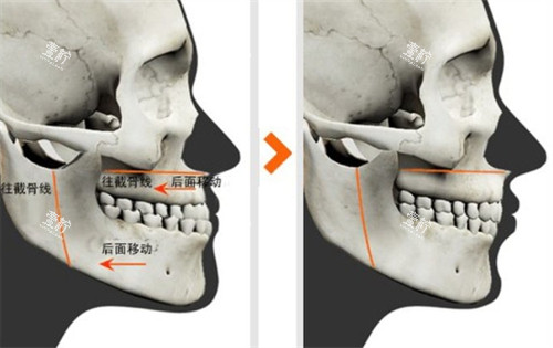 双鄂手术对比图.jpg 双鄂手术对比图.jpg