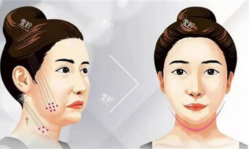 埋线提升卡通图.jpg 埋线提升卡通图.jpg