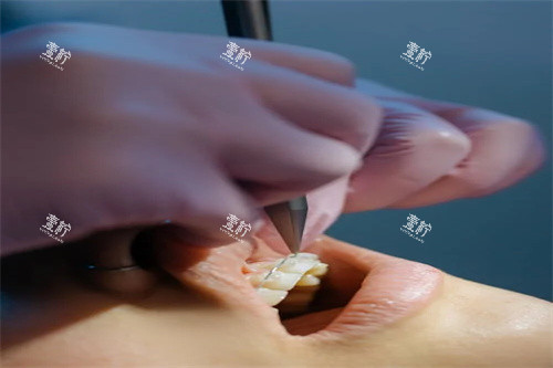 牙齿矫正操作中.jpg 牙齿矫正操作中.jpg