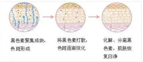 激光祛斑示意图.jpg 激光祛斑示意图.jpg