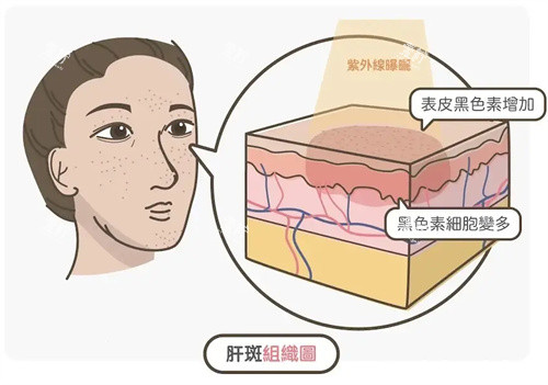 祛斑卡通图.jpg 祛斑卡通图.jpg