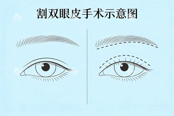 割双眼皮手术示意图.jpg 割双眼皮手术示意图.jpg