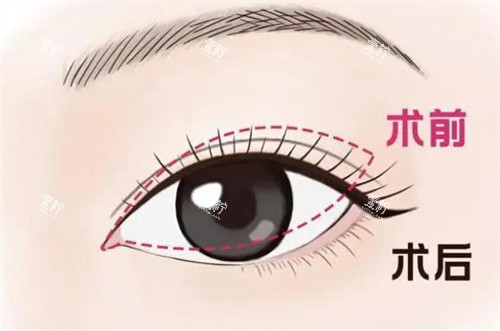 双眼皮修复手术对比.jpg