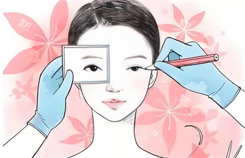 双眼皮手术过程.png 双眼皮手术过程.png