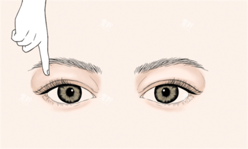 双眼皮手术设计.png
