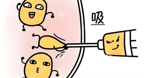 吸脂术动画.jpg