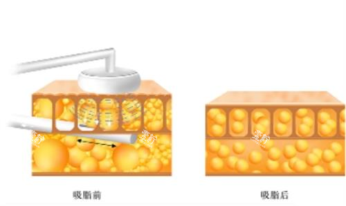吸脂前后对比图.png
