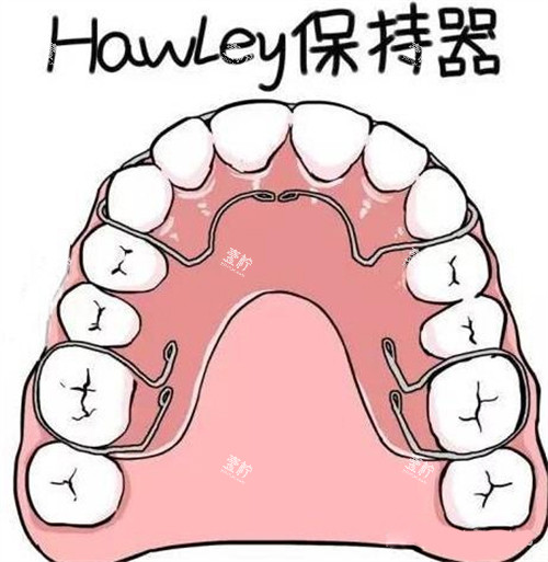 牙齿矫正Hawley哈雷保持器.jpg