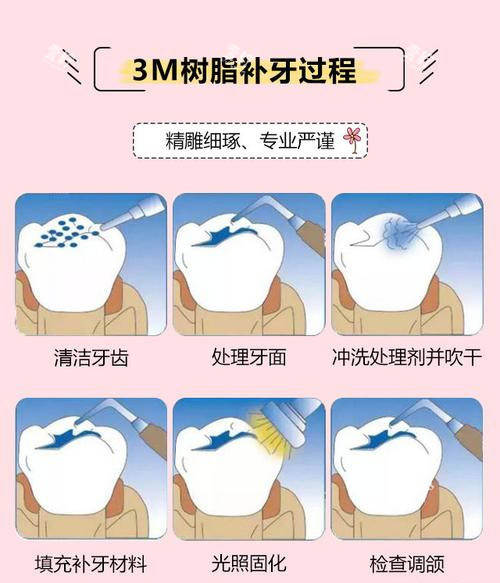 3M树脂补牙方法.jpg