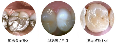 补牙材料示意图.jpg