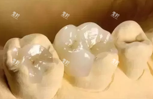 补牙模型展示图.png