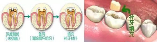补牙过程展示.jpg