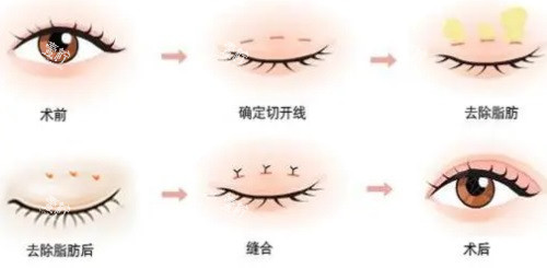 双眼皮手术过程图.JPG
