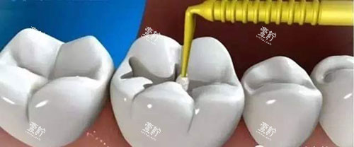 贵港柏乐口腔补牙多少钱？谁能给讲讲这价到底靠不靠谱