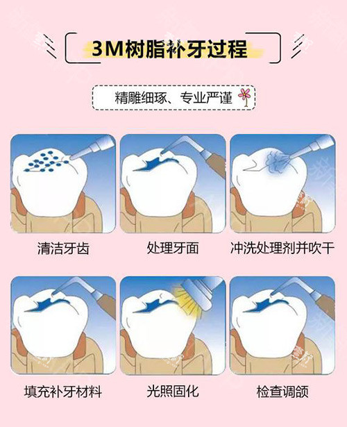 3M树脂补牙过程.jpg