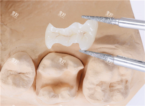 补牙高位嵌体.jpg
