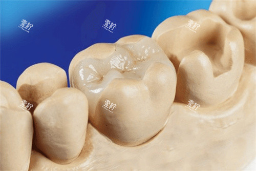 补牙嵌体修复结果.jpg
