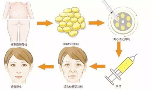 自体脂肪面部填充.jpg