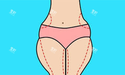 大腿吸脂手术设计方案示意图.jpg