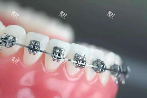 牙齿矫正牙套金属托槽矫正.jpg