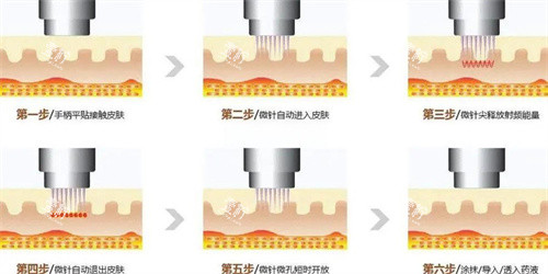 黄金微针.jpg 黄金微针.jpg