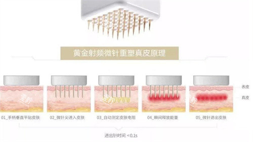 黄金微针原理.jpg 黄金微针原理.jpg