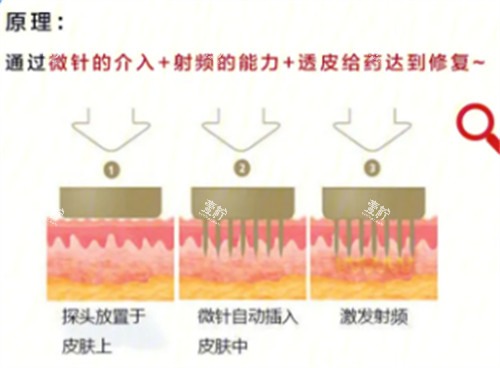 黄金微针原理分析.jpg 黄金微针原理分析.jpg