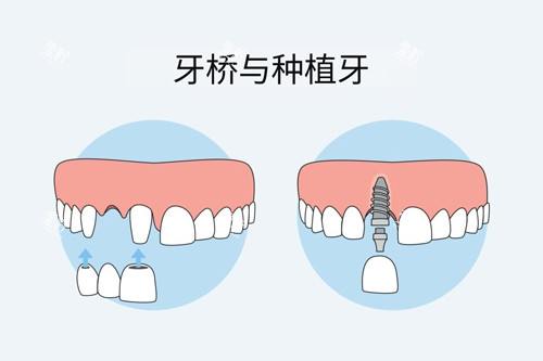 牙冠桥和种植牙对比图.jpg
