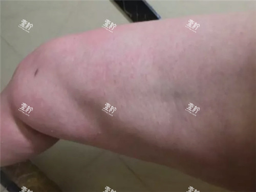 吸脂凹凸不平图示.jpg 吸脂凹凸不平图示.jpg