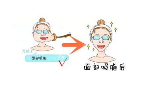 面部吸脂术后示意图.jpg