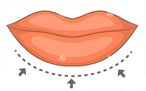 厚唇改薄画线示意图.png