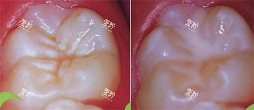 窝沟封闭前后.jpg
