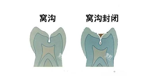 窝沟封闭前后的对比图.png