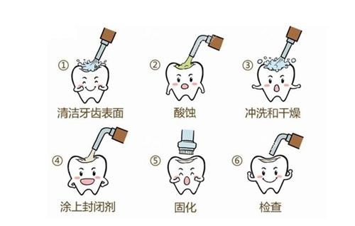 窝沟封闭流程图.png