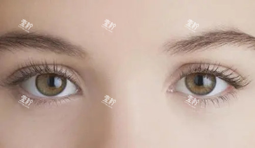 开眼角手术.webp.jpg