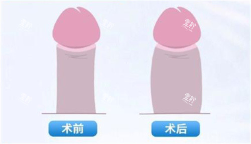 男性私密脂肪填充.jpg