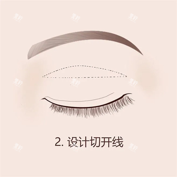 双眼皮手术.jpg