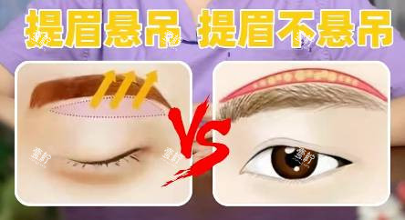 cfs悬吊术示意图.jpg cfs悬吊术示意图.jpg