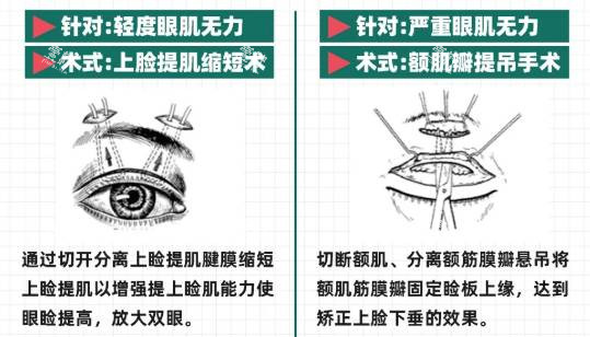 cfs额肌悬吊手术示意图.jpg