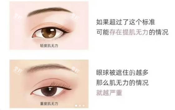 cfs眼肌无力.jpg
