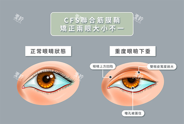 眼肌无力cfs悬吊术.jpg