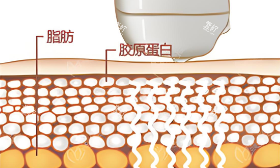 激光溶脂图.png 激光溶脂图.png